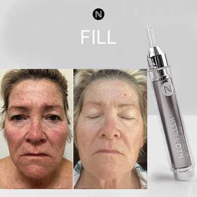 Fill Lift and Glow